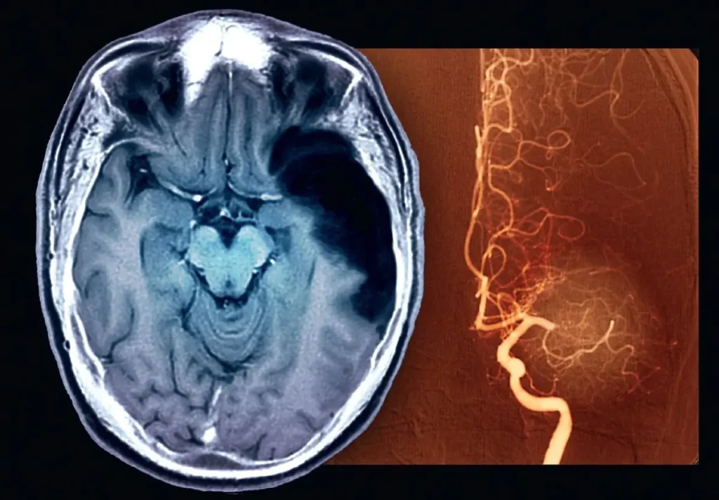 Ischämischer Schlaganfall – Ursachen, Symptome, Behandlung und Prognose verständlich erklärt ischämischer schlaganfall